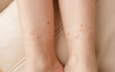 How to Identify Flea Bites in Orange County Homes