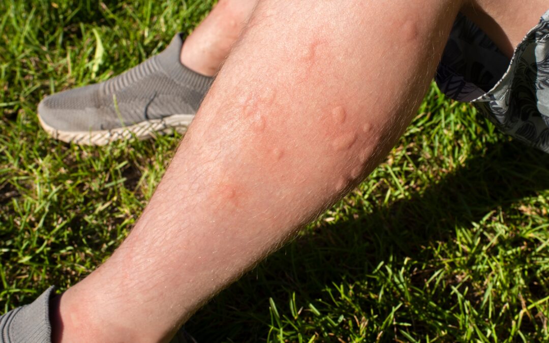 Skeeter Syndrome Turns Ordinary Mosquito Bites Into Big Reactions