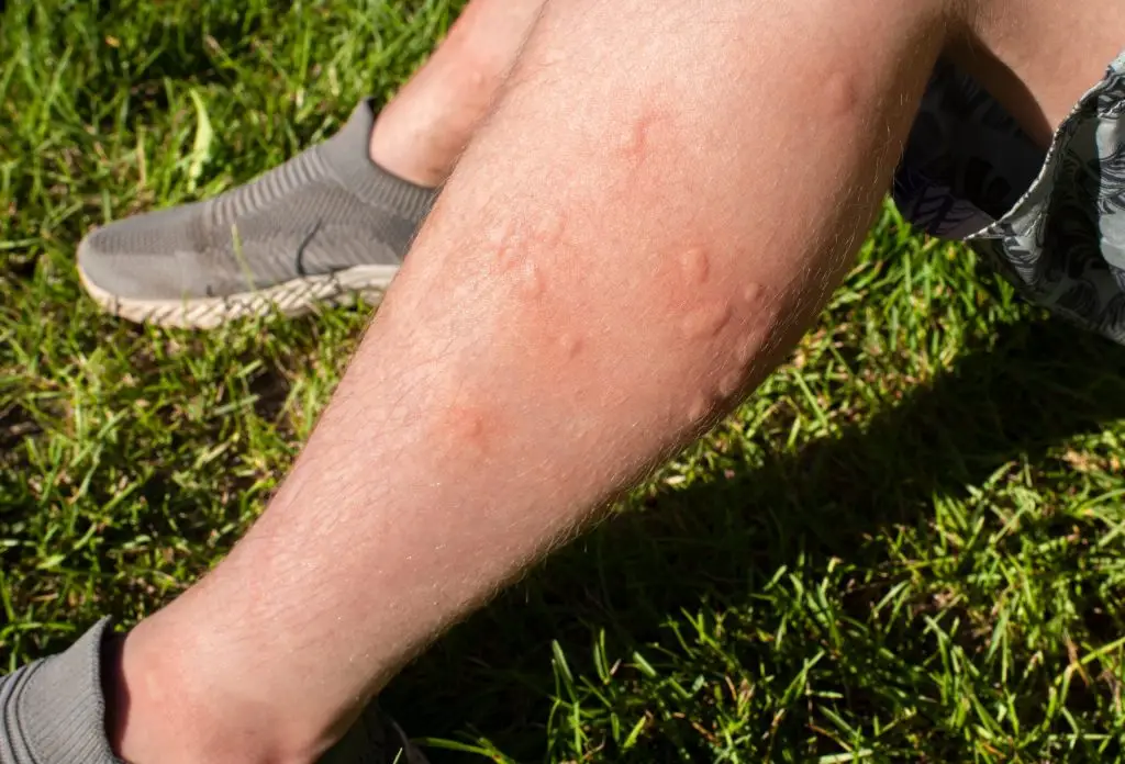Person's leg showing multiple red, swollen mosquito bites on grass